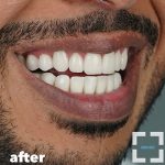 How Much Do Aligners Cost? How Much Do Aligners Cost?