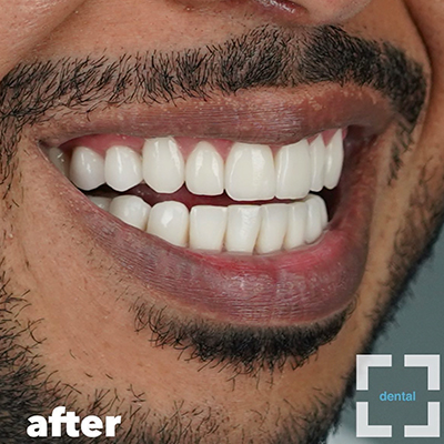 How Much Do Aligners Cost? How Much Do Aligners Cost?